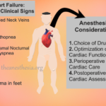What is Congestive Heart Failure?. Anesthesia Considerations of CHF.